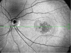 Retinal Photo