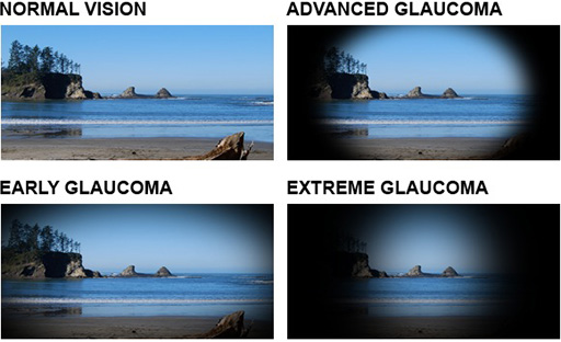 glaucoma